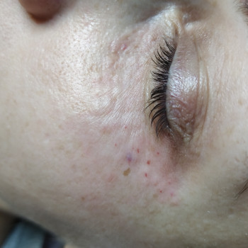 Биоревитализация
                    Врач-косметолог Майя Киев