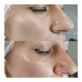 Контурна пластика обличчя