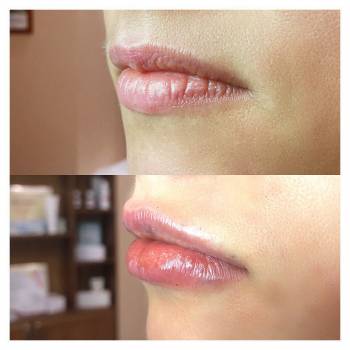 Увеличение губ