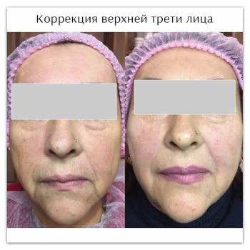 Коррекция верхней трети лица