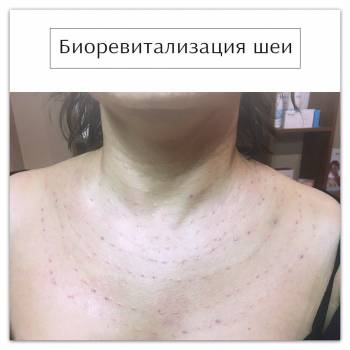 Биоревитализация