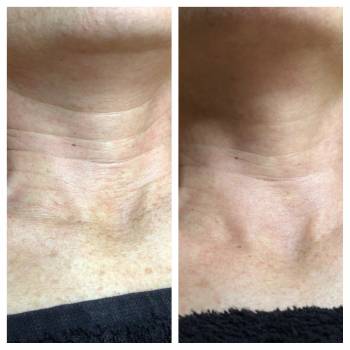 Биоревитализация. 1 процедура