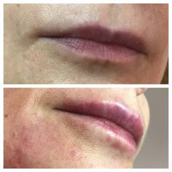 Контурная пластика