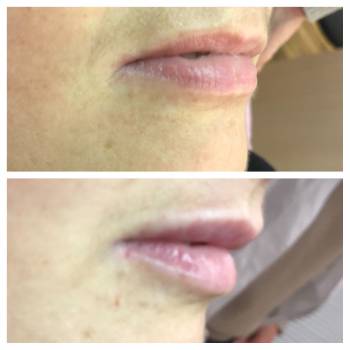 Контурная пластика. 