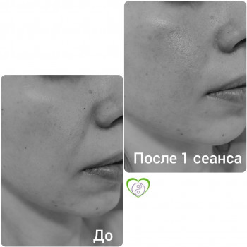 возможные результаты сразу после процедуры миолифтингового м