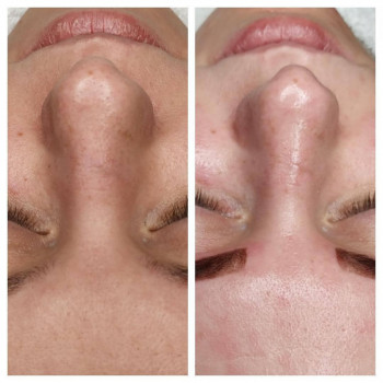 Ультразвуковая чистка лица
                    Лікар-косметолог Любовь Запоріжжя