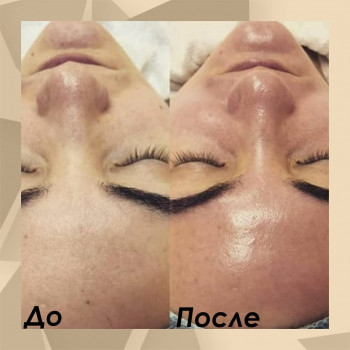 Ультразвуковая чистка лица
                    Лікар-косметолог Любовь Запоріжжя