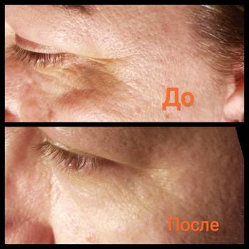 Мезотерапия для век