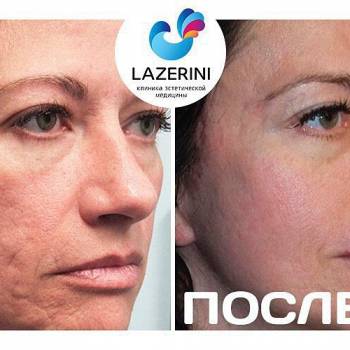 удаление татуажа, коррекция морщин