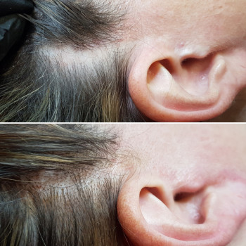 Закриття шрамів після підтяжки обличчя