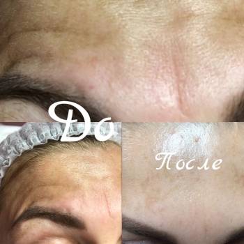 коррекция мимических морщин препаратом Ботокс