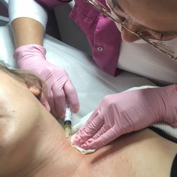 плазмолифтинг