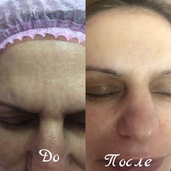 авторская процедура "мгновенный лифтинг"