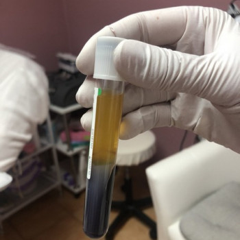 Плазмолифтинг
                    Салон краси Богиня Київ