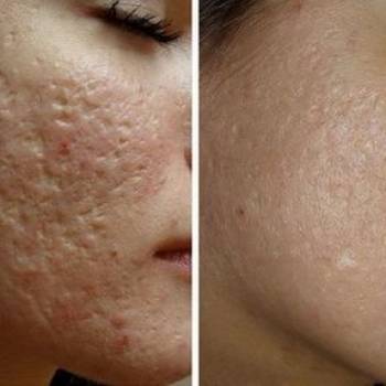 лазерная шлифовка