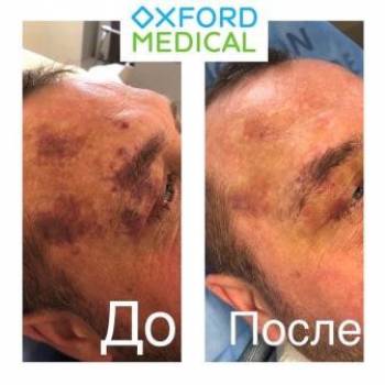 удаление гемангиом