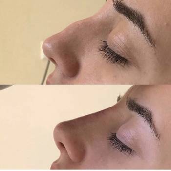 коррекция носа