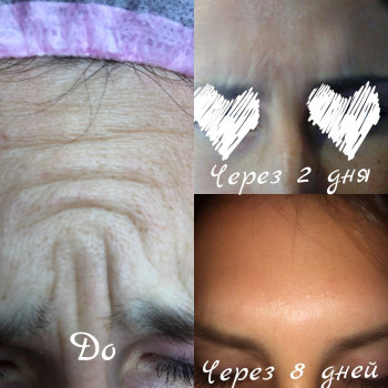 Ботулинотерапия (ботокс, диспорт)
                    Врач-косметолог Алина Киев