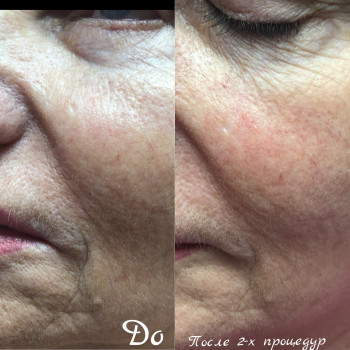 Мезотерапия лица и тела
                    Врач-косметолог Алина Киев