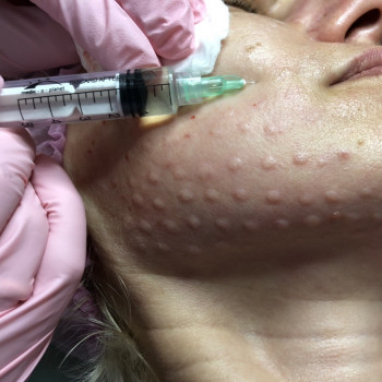 Мезотерапия лица и тела
                    Врач-косметолог Алина Киев