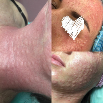 Мезотерапия лица и тела
                    Врач-косметолог Алина Киев