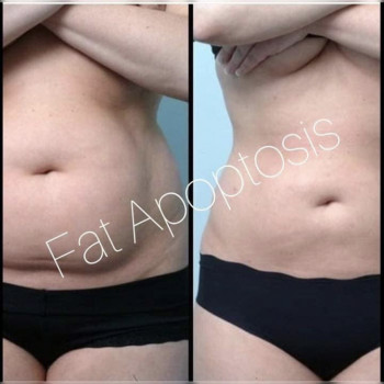 Мезотерапия лица и тела
                    Врач-косметолог Алина Киев