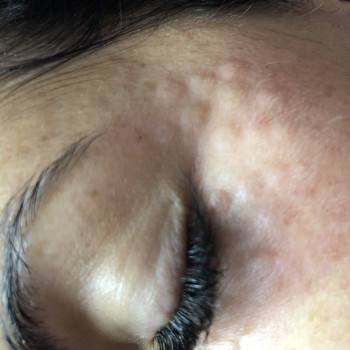 Мезотерапия лица и тела
                    Врач-косметолог Алина Киев