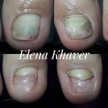 Медичний педикюр
                    Подолог Елена Олеговна Черкаси