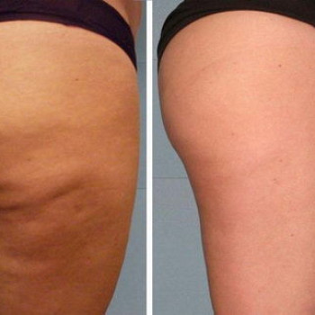 Массаж антицеллюлитный
                    Косметолог Дарья Маріуполь