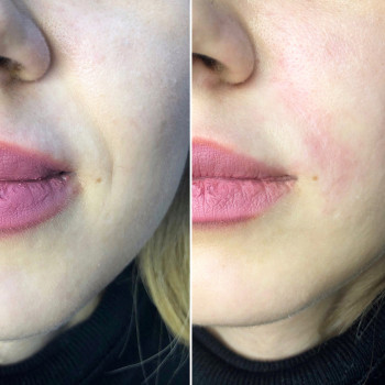 Контурная пластика носогубных складок
                    Косметолог Анна Гетьман Харків