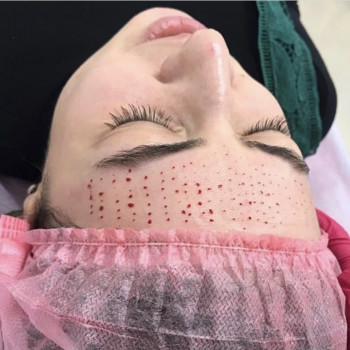 Биоревитализация
                    Косметолог Анна Гетьман Харьков