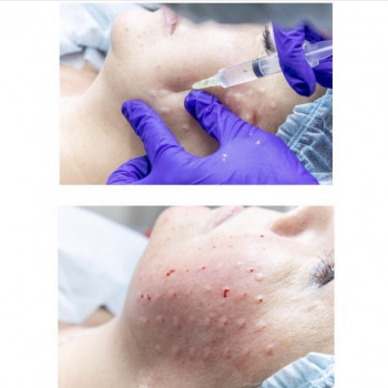 Биоревитализация
                    Косметолог Анна Гетьман Харьков