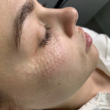 Биоревитализация
                    Косметолог Анна Гетьман Харьков