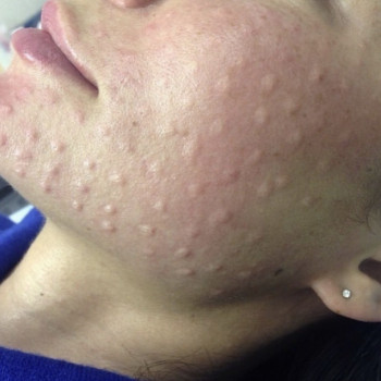 Биоревитализация
                    Косметолог Анна Гетьман Харьков