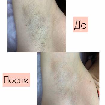 Шугаринг зони пахв