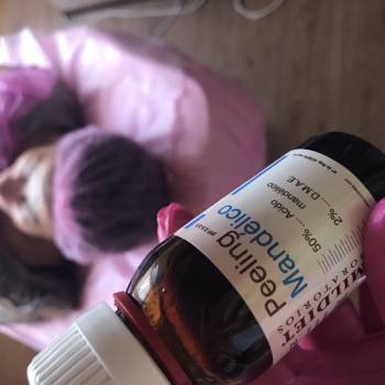 Процедура поверхневого мигдального пілінгу