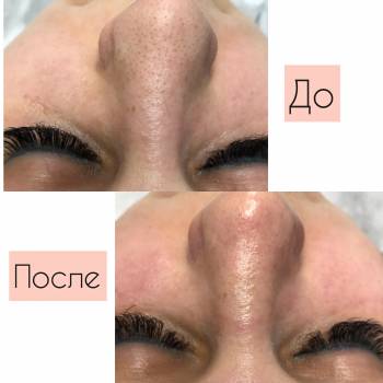 Результат комбінованої чистки