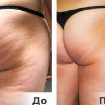 корекція фігури