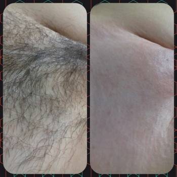 Бикини после бритвы 2 месяца.