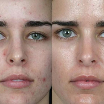 Чистка лица до и через 2 недели после процедуры