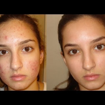 Чистка лица до и через 2 недели после процедуры