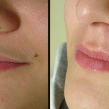 Депиляция усики