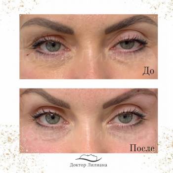 Броулифтинг