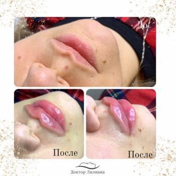 Контурная пластика губ