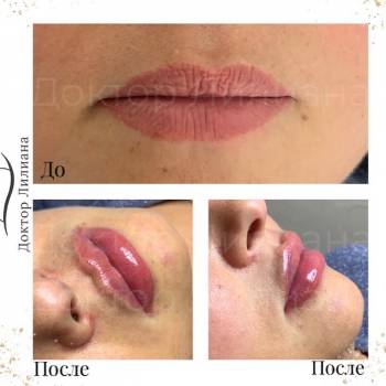 Контурная пластика губ