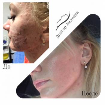 Комплексное лечение проблемной кожи