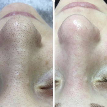 Ультразвуковая чистка лица
                    Косметолог Анна Гетьман Харків