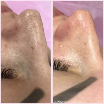 Ультразвуковая чистка лица
                    Косметолог Анна Гетьман Харків