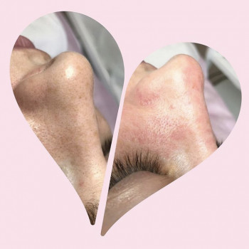 Ультразвуковая чистка лица
                    Косметолог Анна Гетьман Харків