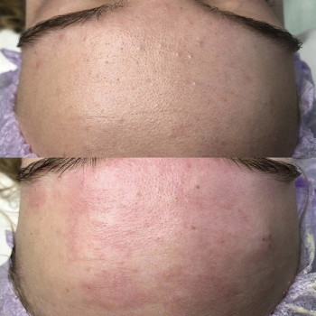 Ультразвуковая чистка лица
                    Косметолог Анна Гетьман Харків